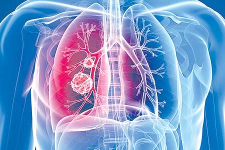 Webinar: A Comparison of Two Liquid Biopsy Approaches in Advanced Lung ...